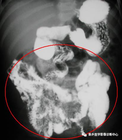 值夜班不能忽视的10种儿童腹痛原因 值夜班不能忽视的10种儿童腹痛原因