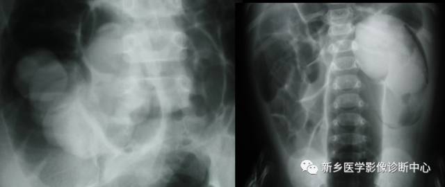 值夜班不能忽视的10种儿童腹痛原因 值夜班不能忽视的10种儿童腹痛原因