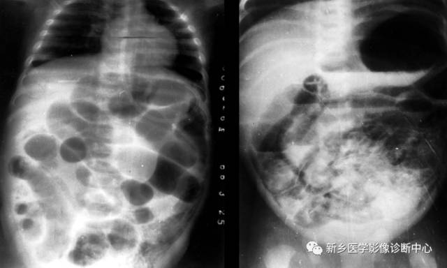 值夜班不能忽视的10种儿童腹痛原因 值夜班不能忽视的10种儿童腹痛原因
