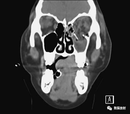 眼眶爆裂性骨折的CT表现、眼眶解剖 眼眶爆裂性骨折的CT表现、眼眶解剖