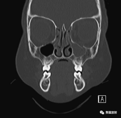 眼眶爆裂性骨折的CT表现、眼眶解剖 眼眶爆裂性骨折的CT表现、眼眶解剖