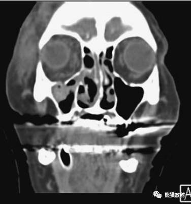 眼眶爆裂性骨折的CT表现、眼眶解剖 眼眶爆裂性骨折的CT表现、眼眶解剖