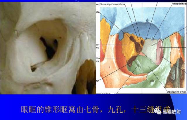 眼眶爆裂性骨折的CT表现、眼眶解剖 眼眶爆裂性骨折的CT表现、眼眶解剖