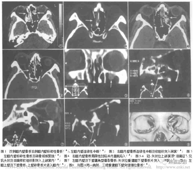 眼眶爆裂性骨折的CT表现、眼眶解剖 眼眶爆裂性骨折的CT表现、眼眶解剖