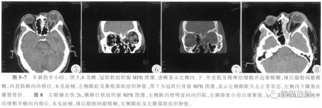 眼眶爆裂性骨折的CT表现、眼眶解剖 眼眶爆裂性骨折的CT表现、眼眶解剖