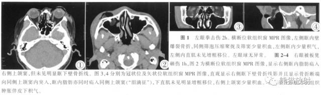 眼眶爆裂性骨折的CT表现、眼眶解剖 眼眶爆裂性骨折的CT表现、眼眶解剖