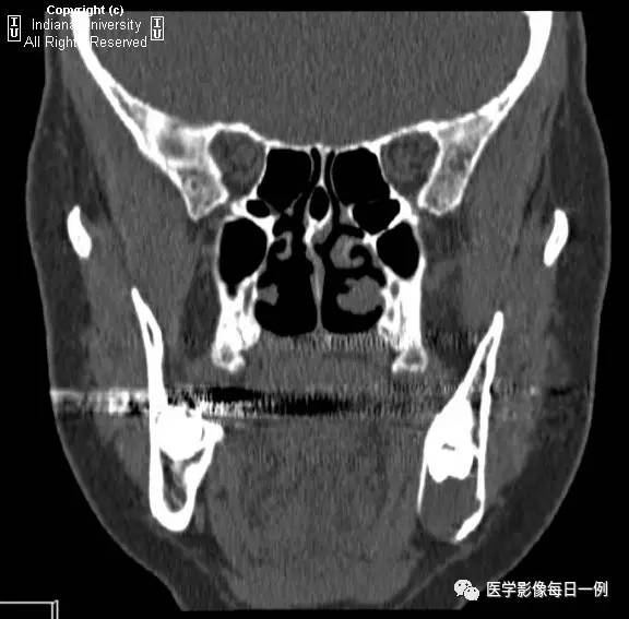 【病例】含牙囊肿1例CT影像表现 【病例】含牙囊肿1例CT影像表现