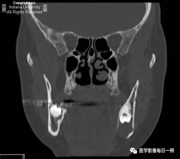 【病例】含牙囊肿1例CT影像表现 【病例】含牙囊肿1例CT影像表现