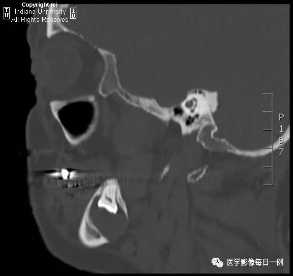 【病例】含牙囊肿1例CT影像表现
