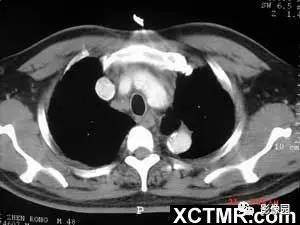 【病例】肺结节病1例CT影像表现 【病例】肺结节病1例CT影像表现