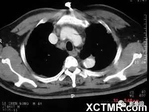 【病例】肺结节病1例CT影像表现 【病例】肺结节病1例CT影像表现