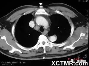 【病例】肺结节病1例CT影像表现 【病例】肺结节病1例CT影像表现