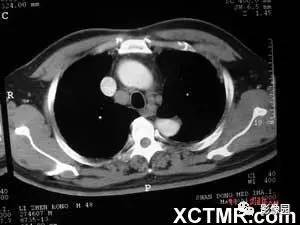 【病例】肺结节病1例CT影像表现 【病例】肺结节病1例CT影像表现