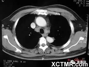 【病例】肺结节病1例CT影像表现 【病例】肺结节病1例CT影像表现
