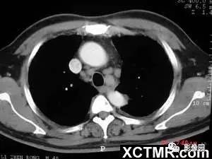 【病例】肺结节病1例CT影像表现 【病例】肺结节病1例CT影像表现