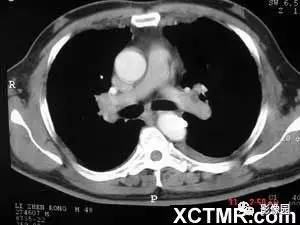 【病例】肺结节病1例CT影像表现 【病例】肺结节病1例CT影像表现