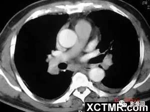 【病例】肺结节病1例CT影像表现 【病例】肺结节病1例CT影像表现