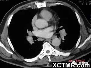 【病例】肺结节病1例CT影像表现 【病例】肺结节病1例CT影像表现