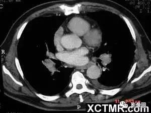 【病例】肺结节病1例CT影像表现 【病例】肺结节病1例CT影像表现