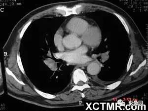 【病例】肺结节病1例CT影像表现 【病例】肺结节病1例CT影像表现