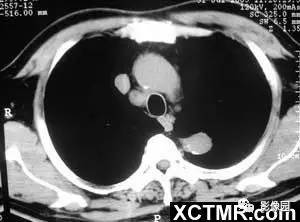 【病例】肺结节病1例CT影像表现 【病例】肺结节病1例CT影像表现