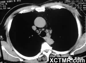 【病例】肺结节病1例CT影像表现 【病例】肺结节病1例CT影像表现