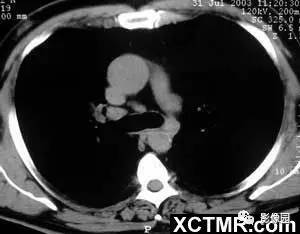 【病例】肺结节病1例CT影像表现 【病例】肺结节病1例CT影像表现
