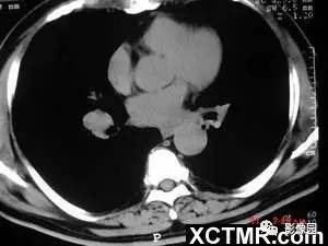 【病例】肺结节病1例CT影像表现 【病例】肺结节病1例CT影像表现