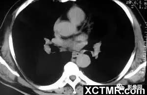 【病例】肺结节病1例CT影像表现 【病例】肺结节病1例CT影像表现