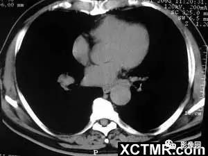 【病例】肺结节病1例CT影像表现 【病例】肺结节病1例CT影像表现