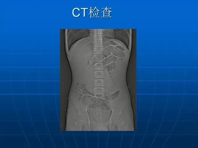 【病例】色素沉着息肉综合征并发小肠多处套叠1例CT