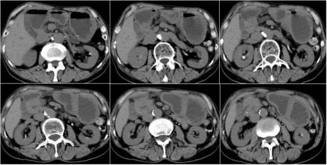 【病例】环状胰腺伴胰腺癌1例CT