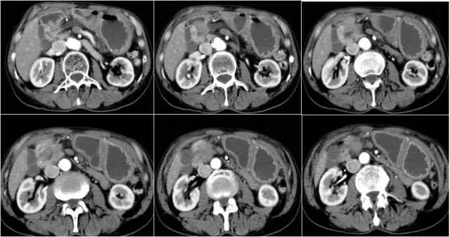 【病例】环状胰腺伴胰腺癌1例CT