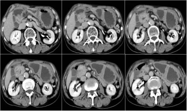 【病例】环状胰腺伴胰腺癌1例CT