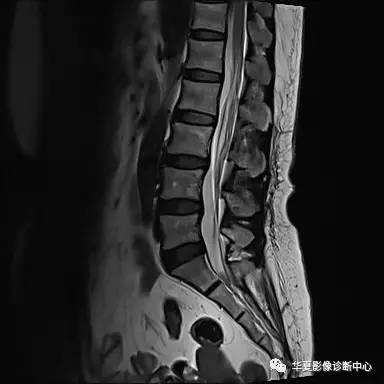 90%的人都不知道的腰椎病变—— 90%的人都不知道的腰椎病变——