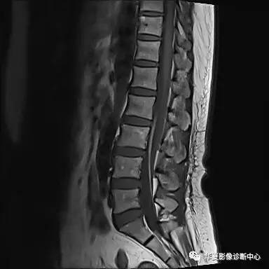 90%的人都不知道的腰椎病变——