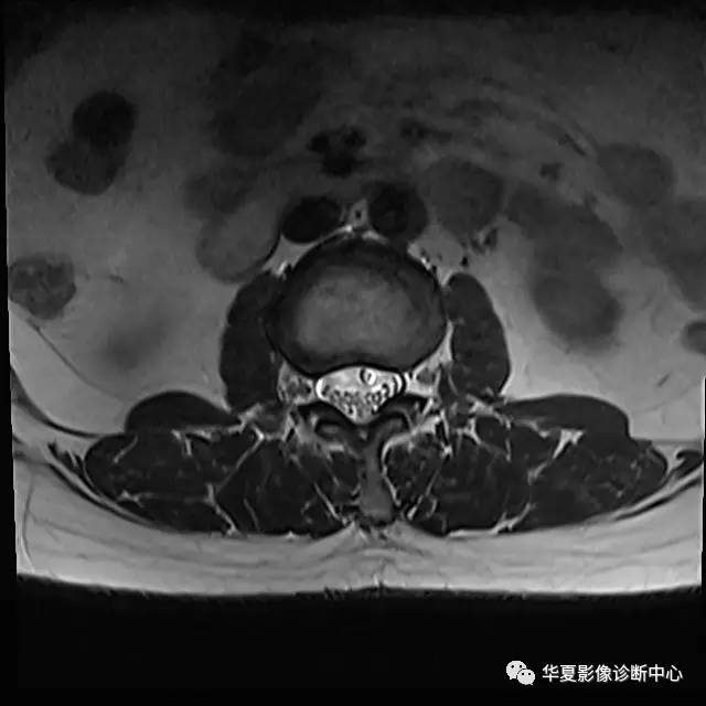 90%的人都不知道的腰椎病变—— 90%的人都不知道的腰椎病变——