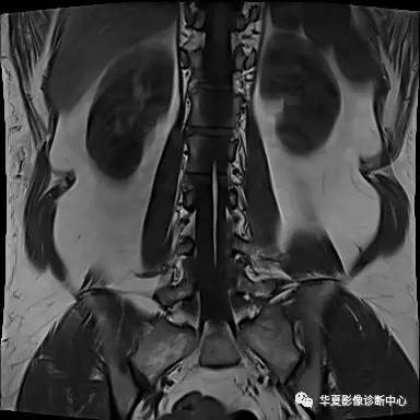 90%的人都不知道的腰椎病变—— 90%的人都不知道的腰椎病变——