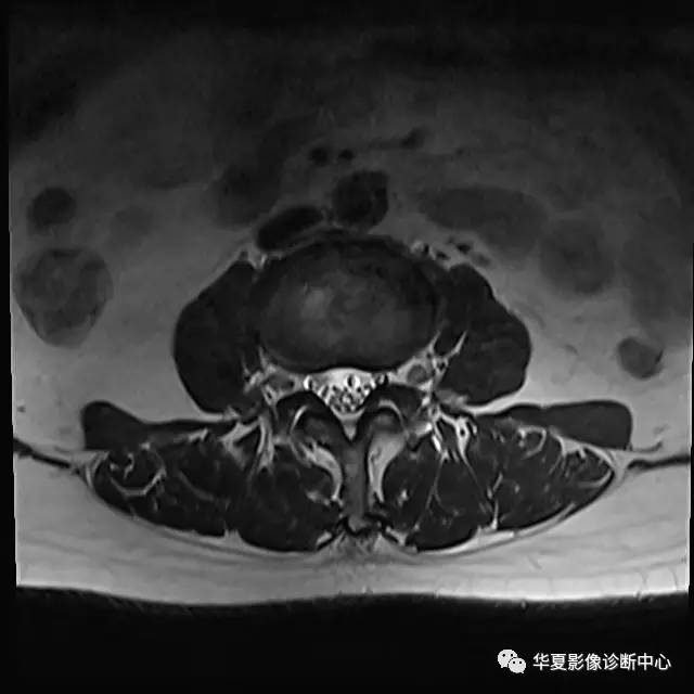90%的人都不知道的腰椎病变—— 90%的人都不知道的腰椎病变——