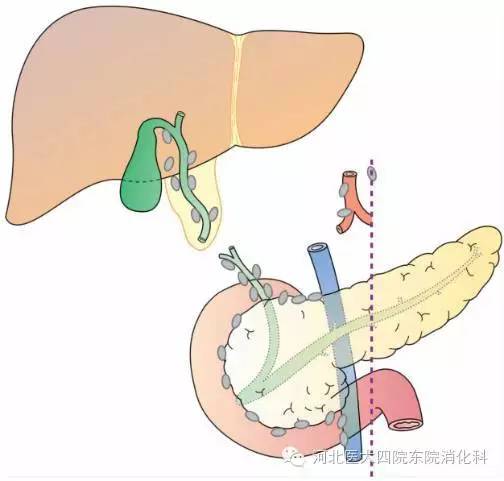 胆囊癌分期、分型、鉴别诊断一次性掌握 胆囊癌分期、分型、鉴别诊断一次性掌握