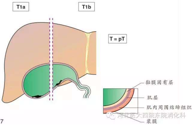 胆囊癌分期、分型、鉴别诊断一次性掌握 胆囊癌分期、分型、鉴别诊断一次性掌握
