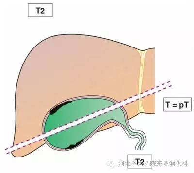胆囊癌分期、分型、鉴别诊断一次性掌握 胆囊癌分期、分型、鉴别诊断一次性掌握