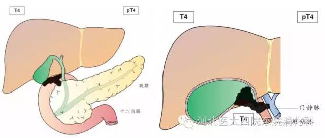 胆囊癌分期、分型、鉴别诊断一次性掌握 胆囊癌分期、分型、鉴别诊断一次性掌握