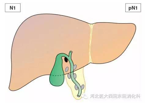 胆囊癌分期、分型、鉴别诊断一次性掌握 胆囊癌分期、分型、鉴别诊断一次性掌握