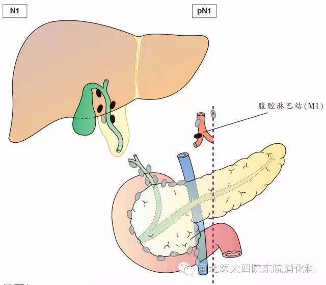 胆囊癌分期、分型、鉴别诊断一次性掌握 胆囊癌分期、分型、鉴别诊断一次性掌握