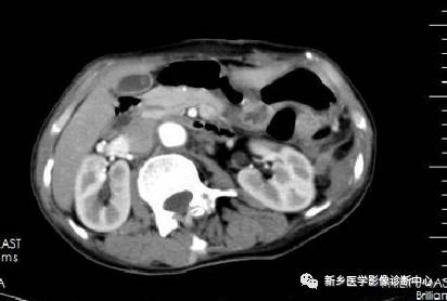 胆囊癌分期、分型、鉴别诊断一次性掌握 胆囊癌分期、分型、鉴别诊断一次性掌握