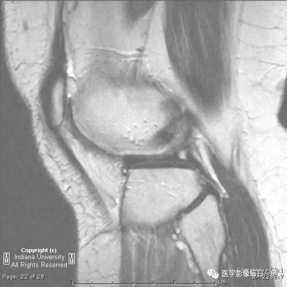 【病例】腓神经腱鞘囊肿1例MR影像表现 【病例】腓神经腱鞘囊肿1例MR影像表现