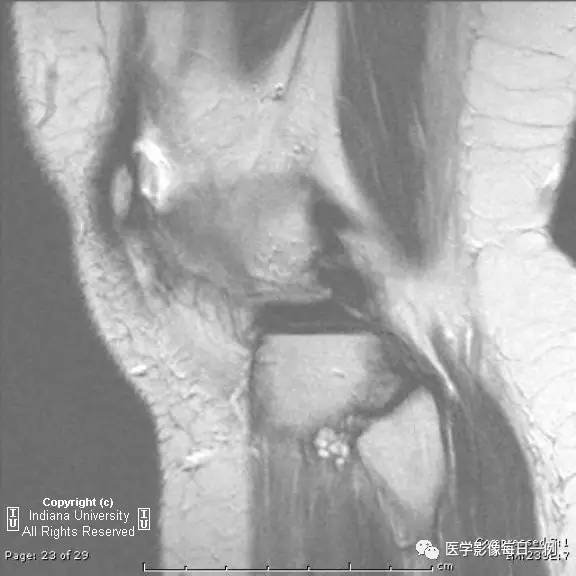 【病例】腓神经腱鞘囊肿1例MR影像表现