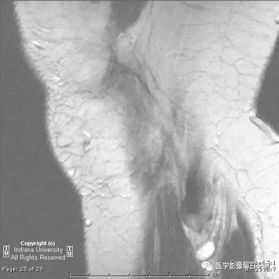 【病例】腓神经腱鞘囊肿1例MR影像表现 【病例】腓神经腱鞘囊肿1例MR影像表现