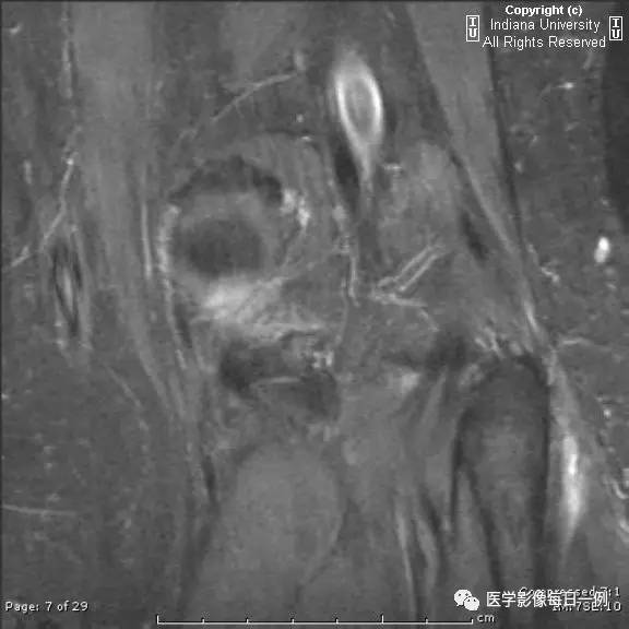 【病例】腓神经腱鞘囊肿1例MR影像表现 【病例】腓神经腱鞘囊肿1例MR影像表现